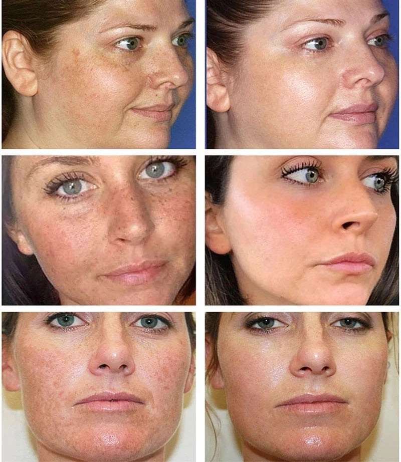 Whitening Freckles Cream Remove Melasma