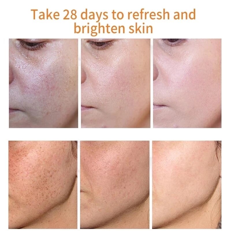 Whitening Freckles Cream Remove Melasma